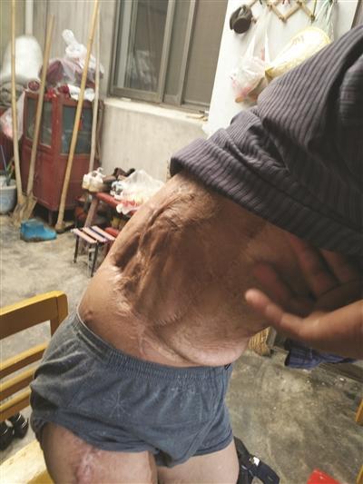 南京男子2年前捡到“铱链” 受辐射落下终身残疾